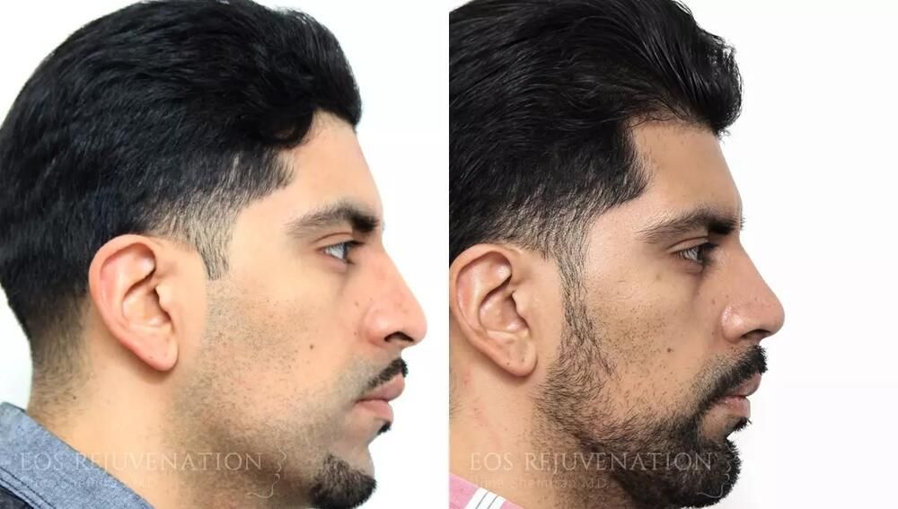 Male Rhinoplasty Before & After