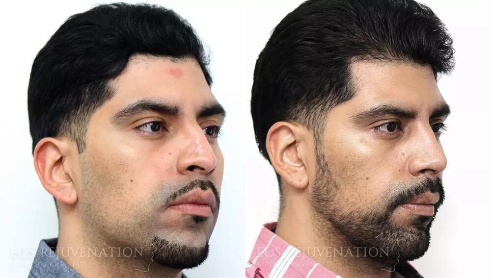Male Rhinoplasty Before & After