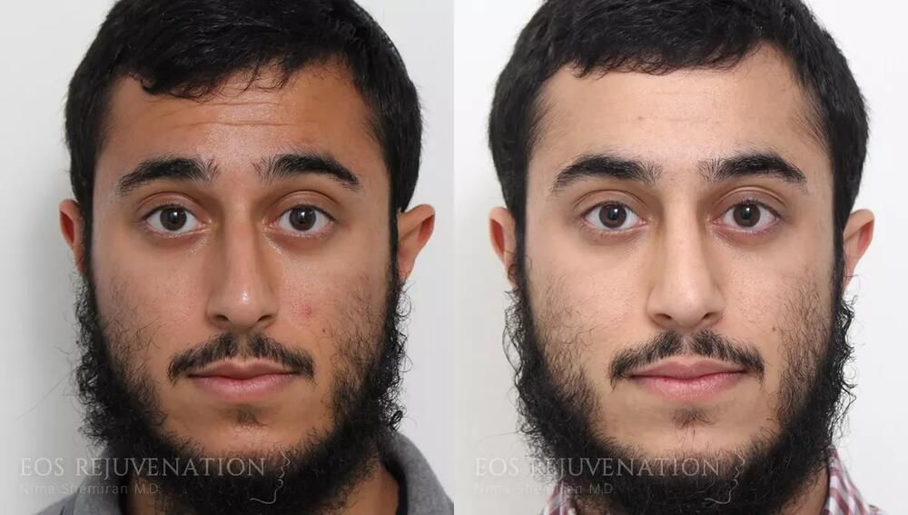 Male Rhinoplasty Before & After