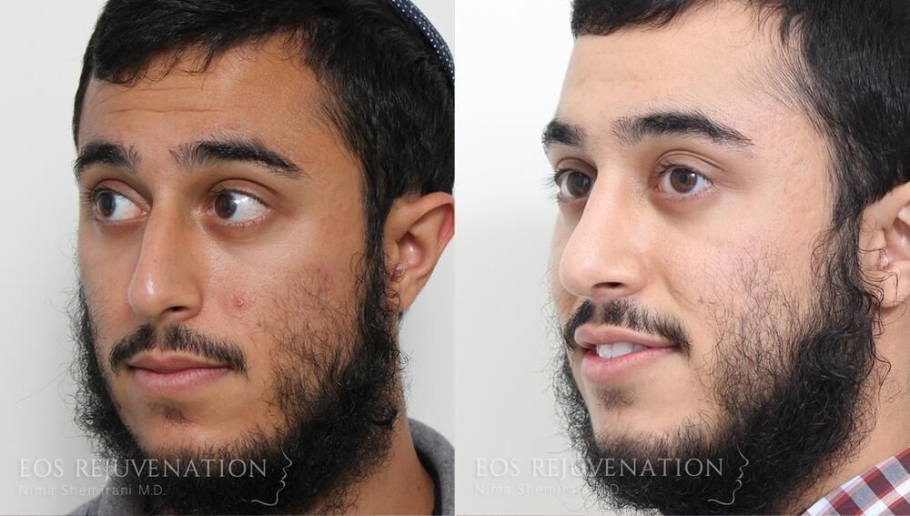 Male Rhinoplasty Before & After