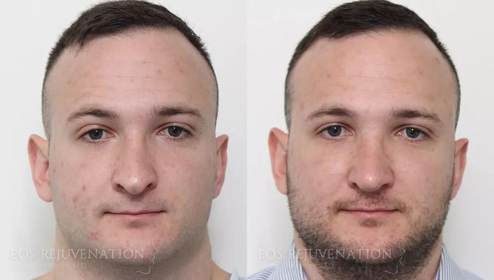 Male Rhinoplasty Before & After