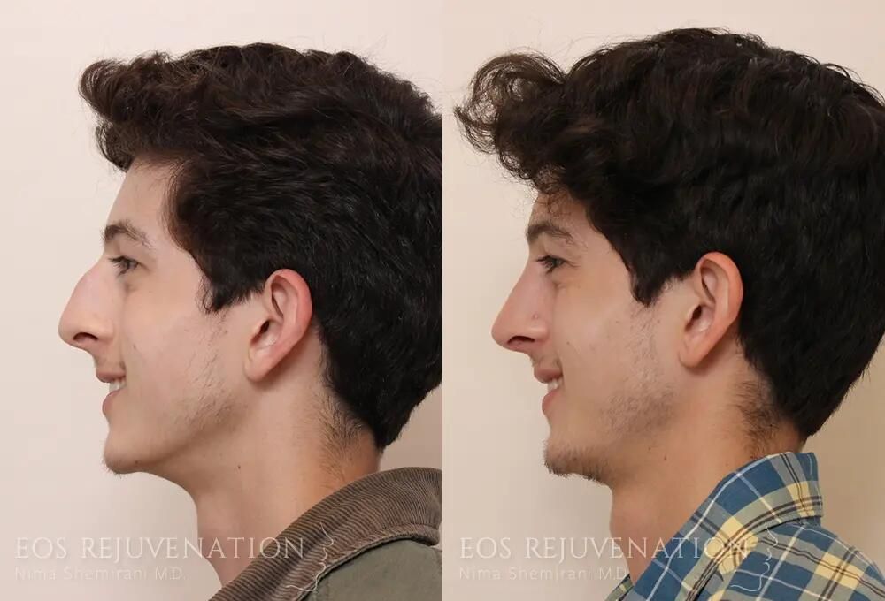 Male Rhinoplasty Before & After