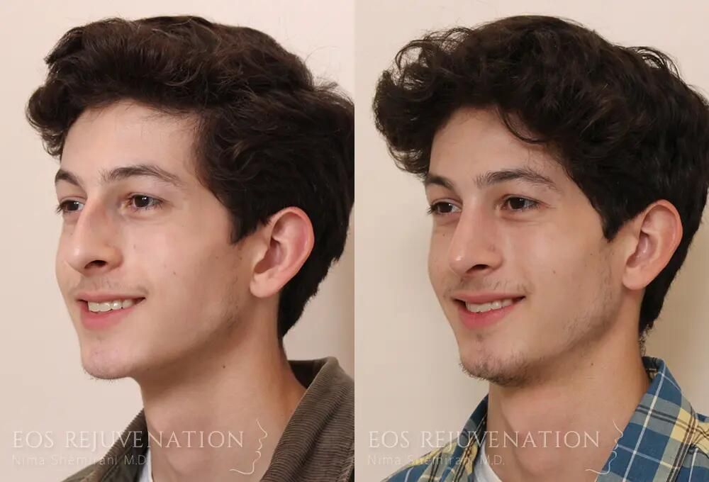 Male Rhinoplasty Before & After