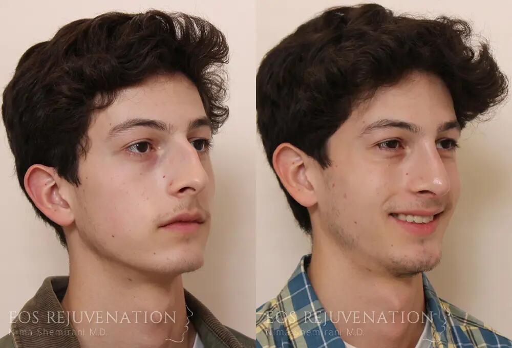 Male Rhinoplasty Before & After