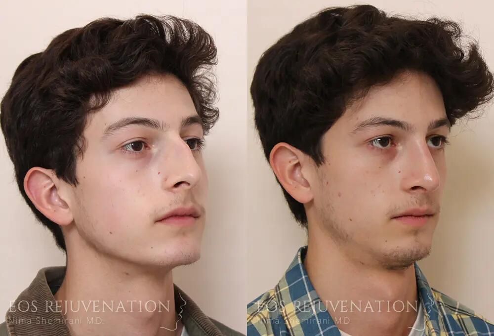 Male Rhinoplasty Before & After
