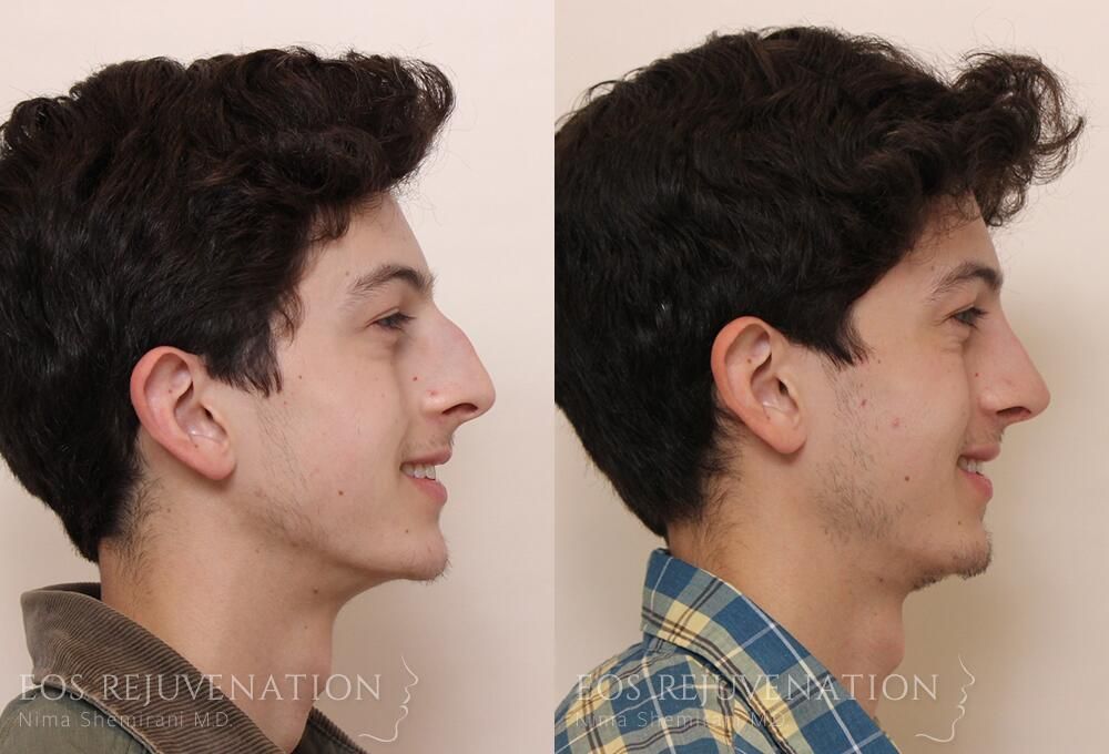 Male Rhinoplasty Before & After
