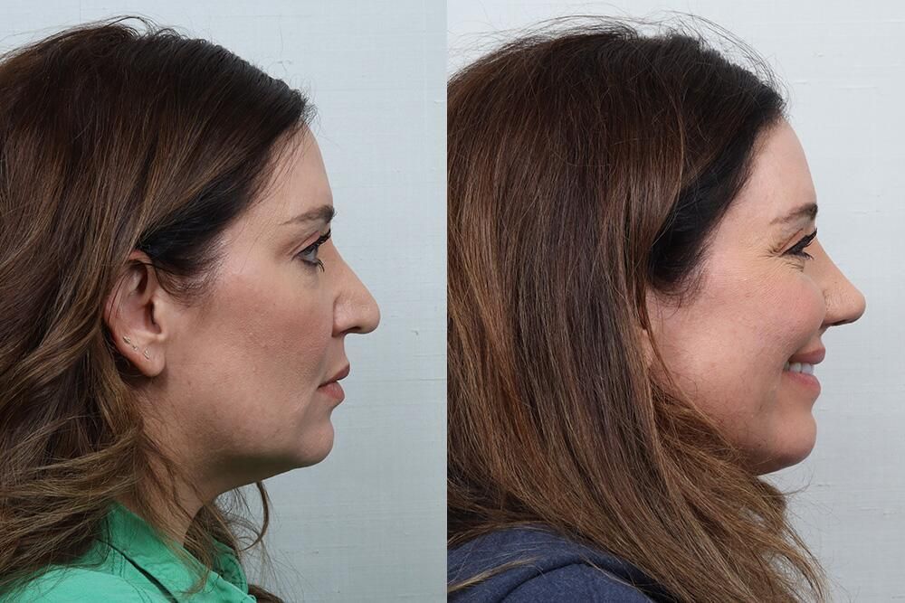 Revision Rhinoplasty Before & After