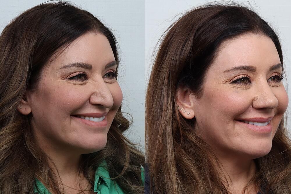 Revision Rhinoplasty Before & After
