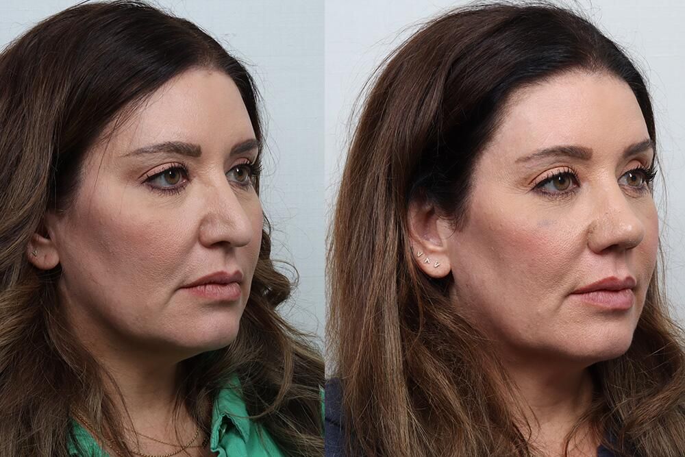 Revision Rhinoplasty Before & After