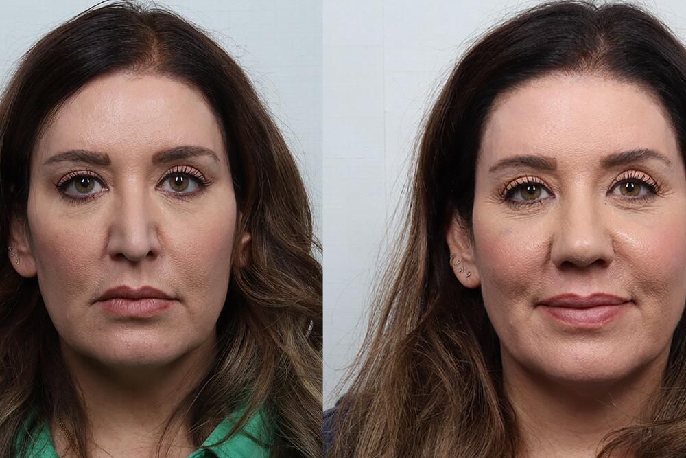 Revision Rhinoplasty Before & After