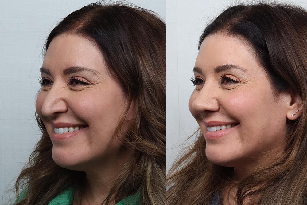 Revision Rhinoplasty Before & After