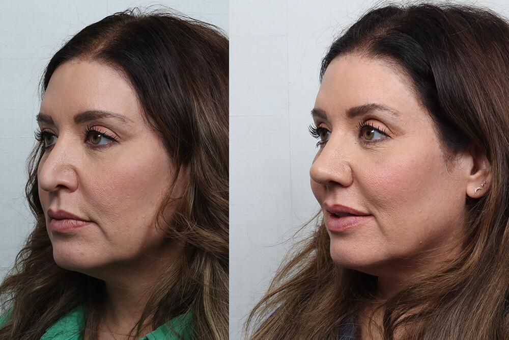 Revision Rhinoplasty Before & After