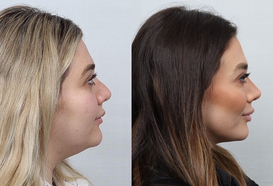 Revision Rhinoplasty Before & After