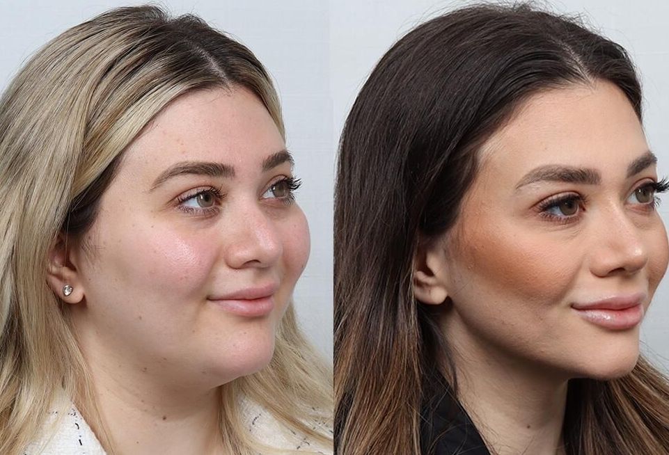 Revision Rhinoplasty Before & After