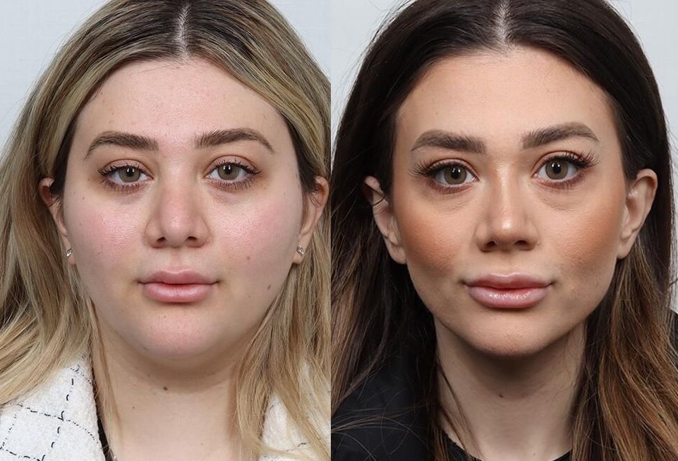 Revision Rhinoplasty Before & After