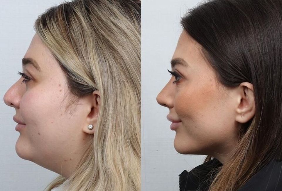 Revision Rhinoplasty Before & After