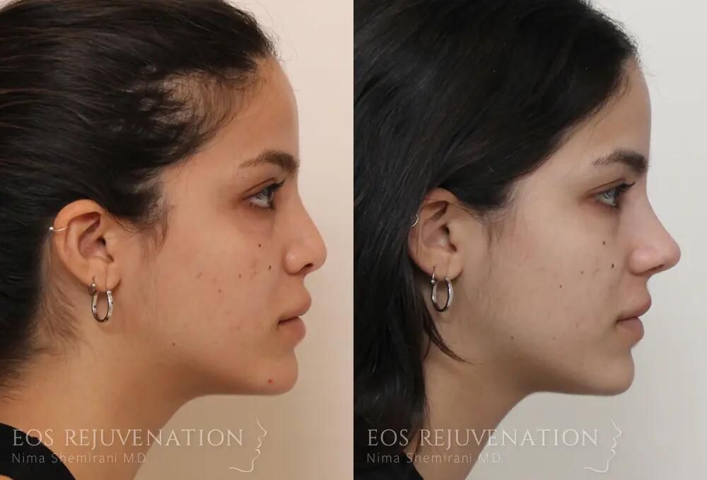 Revision Rhinoplasty Before & After