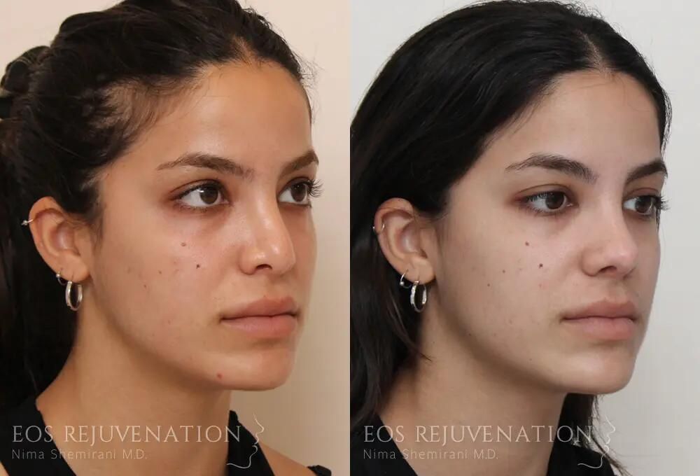 Revision Rhinoplasty Before & After