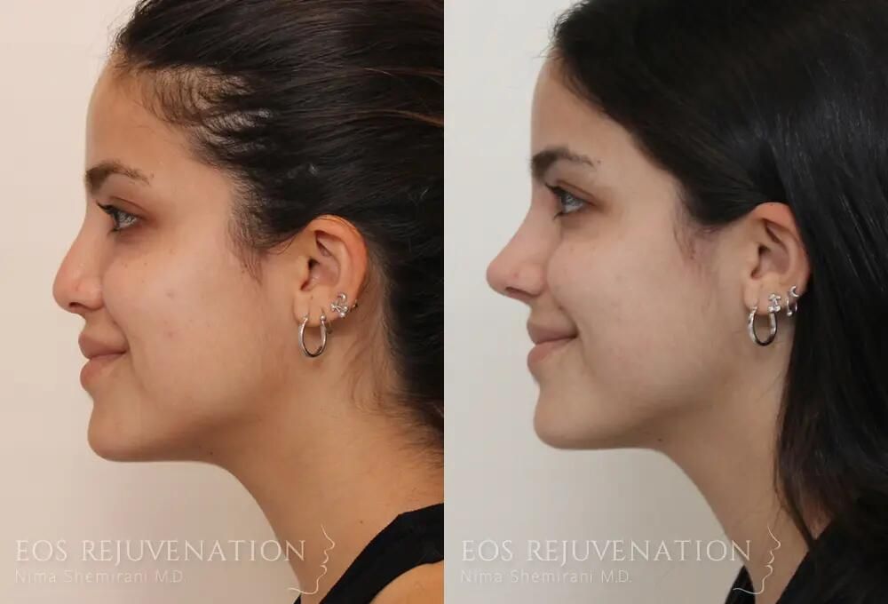 Revision Rhinoplasty Before & After