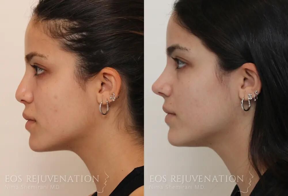 Revision Rhinoplasty Before & After