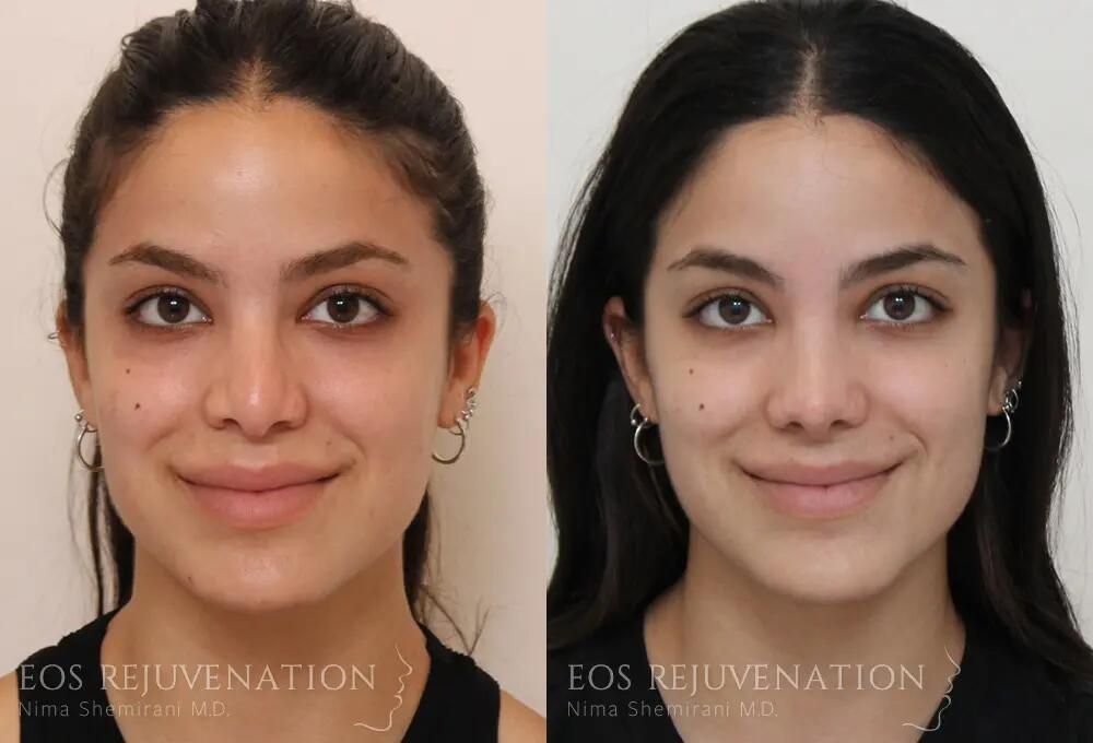 Revision Rhinoplasty Before & After