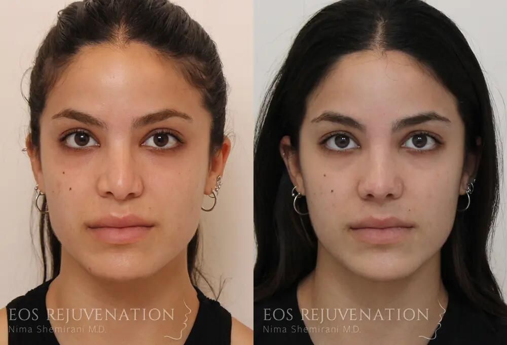 Revision Rhinoplasty Before & After