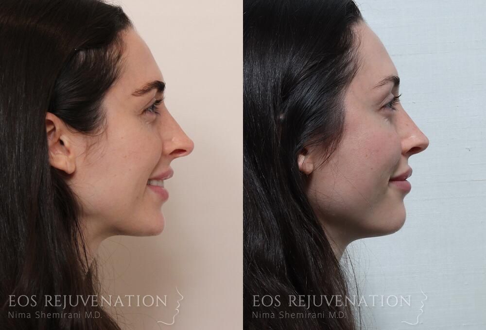 Revision Rhinoplasty Before & After