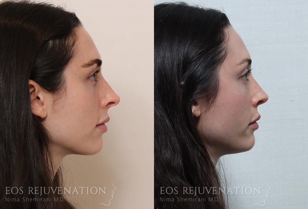 Revision Rhinoplasty Before & After