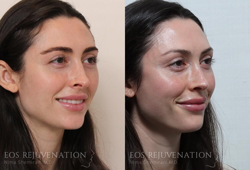 Revision Rhinoplasty Before & After