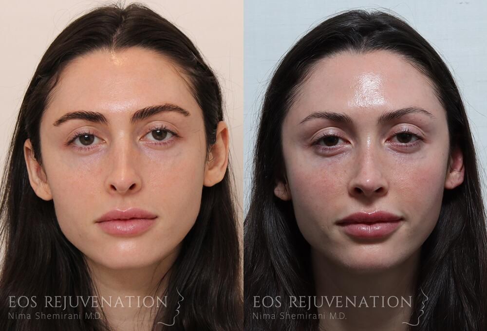 Revision Rhinoplasty Before & After