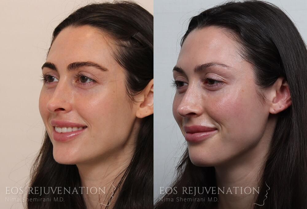 Revision Rhinoplasty Before & After