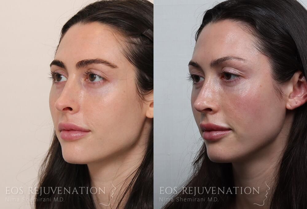 Revision Rhinoplasty Before & After