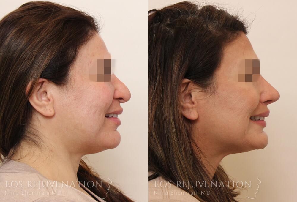 Revision Rhinoplasty Before & After