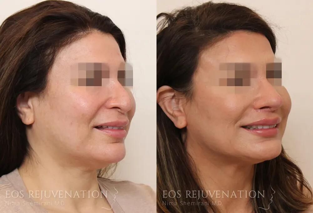 Revision Rhinoplasty Before & After