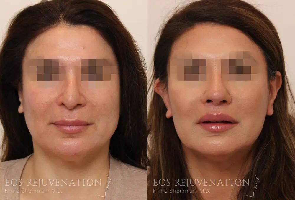 Revision Rhinoplasty Before & After