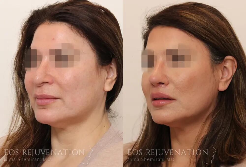 Revision Rhinoplasty Before & After