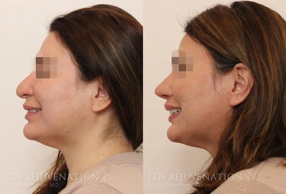 Revision Rhinoplasty Before & After