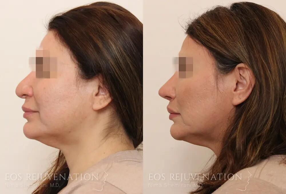 Revision Rhinoplasty Before & After