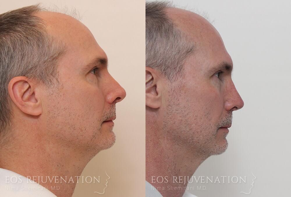 Revision Rhinoplasty Before & After