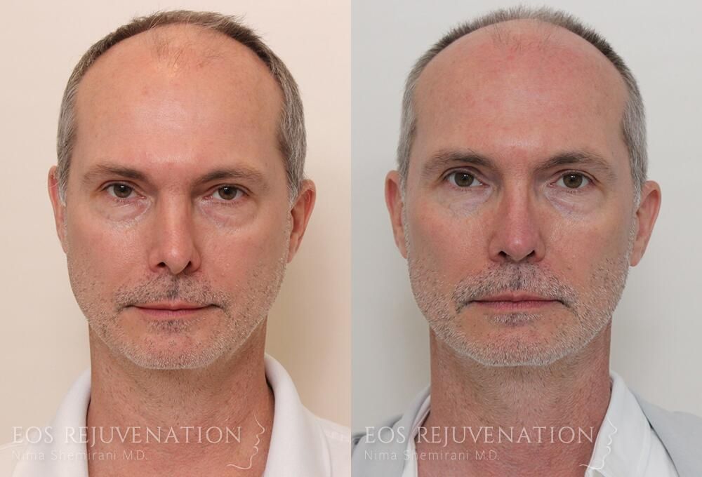 Revision Rhinoplasty Before & After