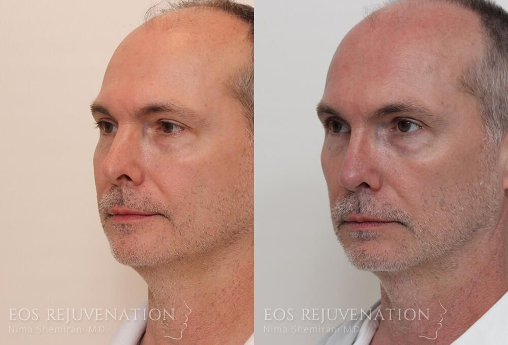 Revision Rhinoplasty Before & After