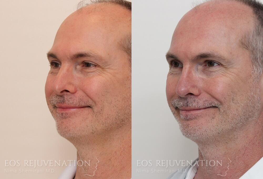 Revision Rhinoplasty Before & After