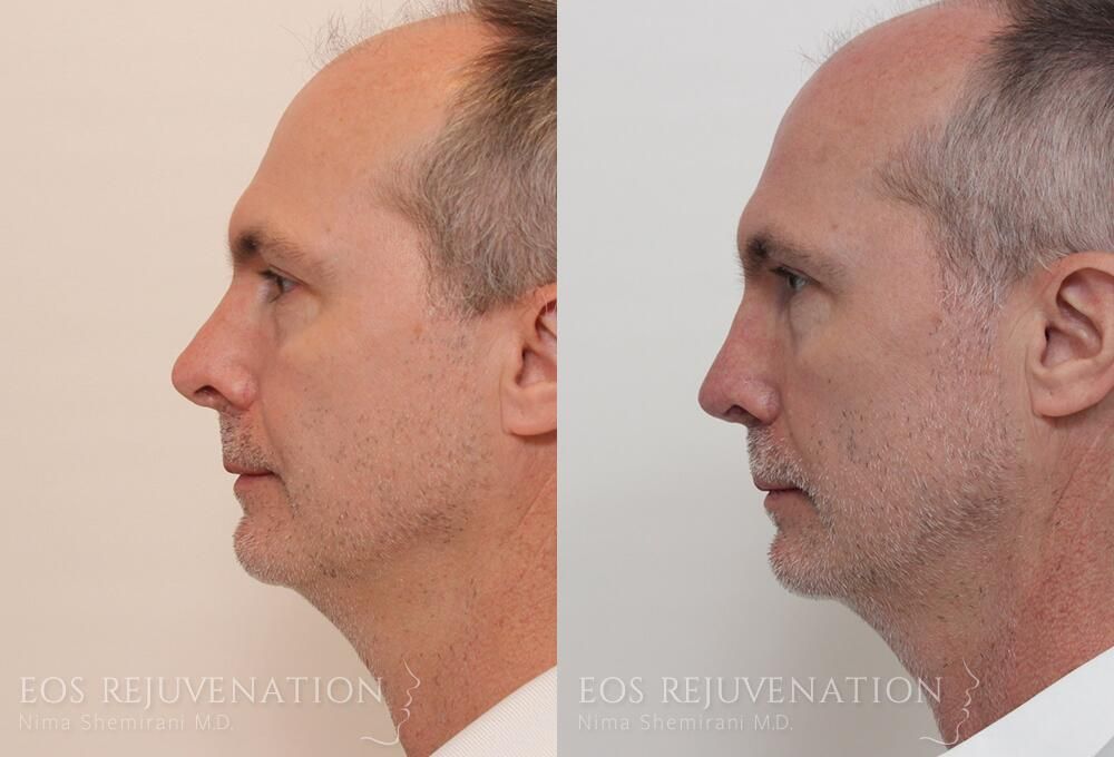 Revision Rhinoplasty Before & After