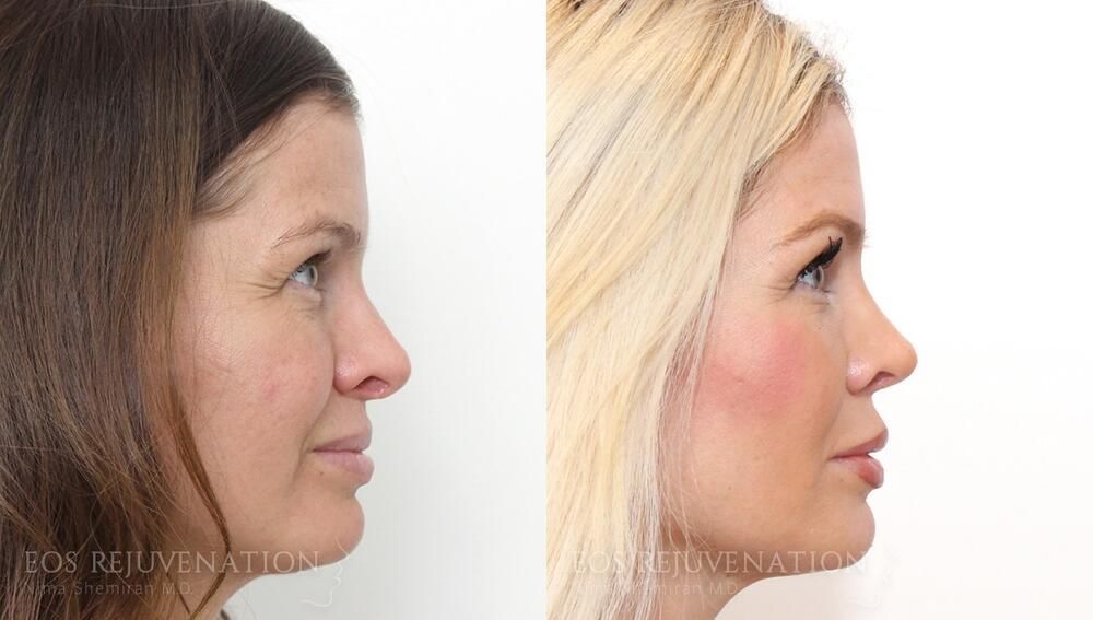 Revision Rhinoplasty Before & After