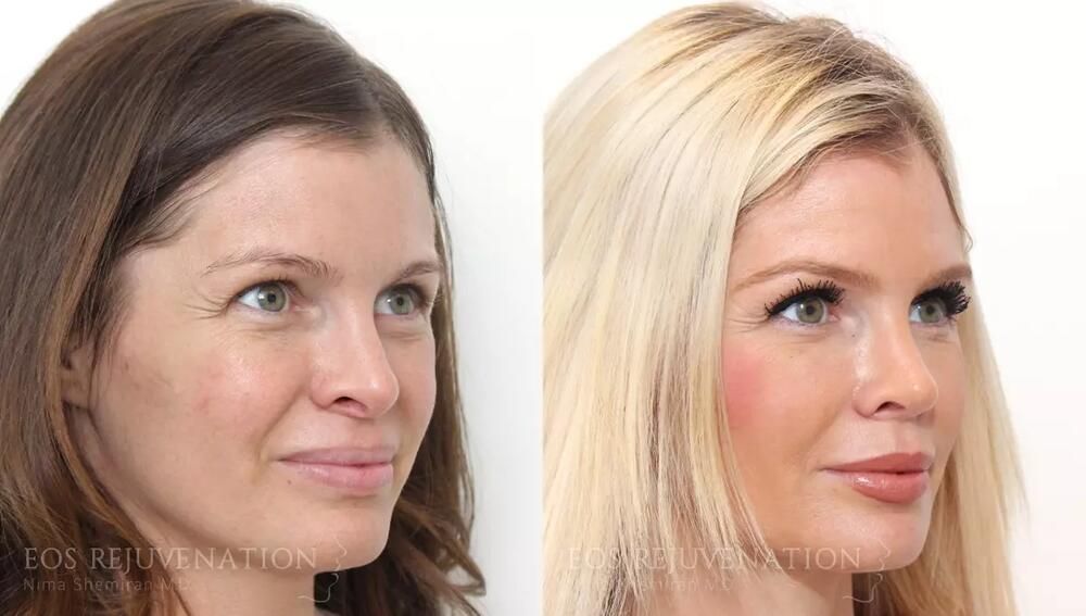 Revision Rhinoplasty Before & After