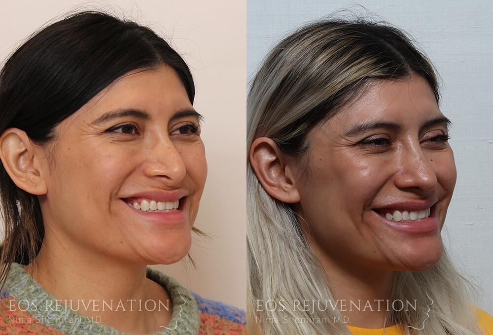 Revision Rhinoplasty Before & After
