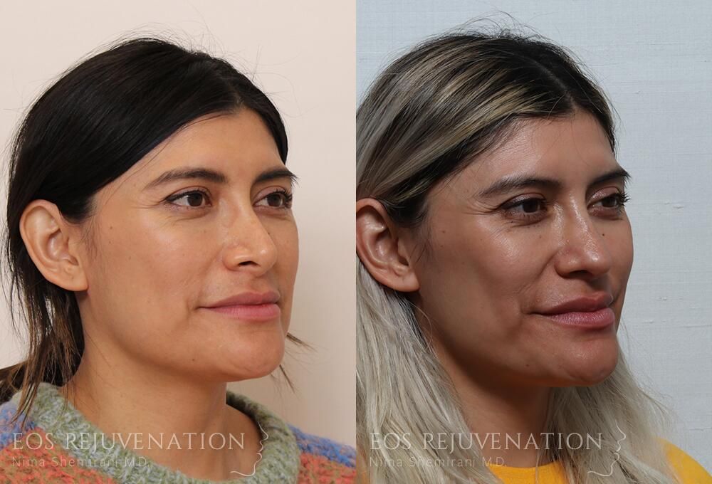 Revision Rhinoplasty Before & After
