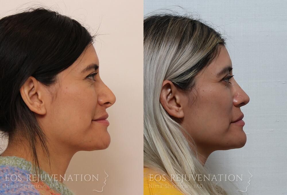 Revision Rhinoplasty Before & After