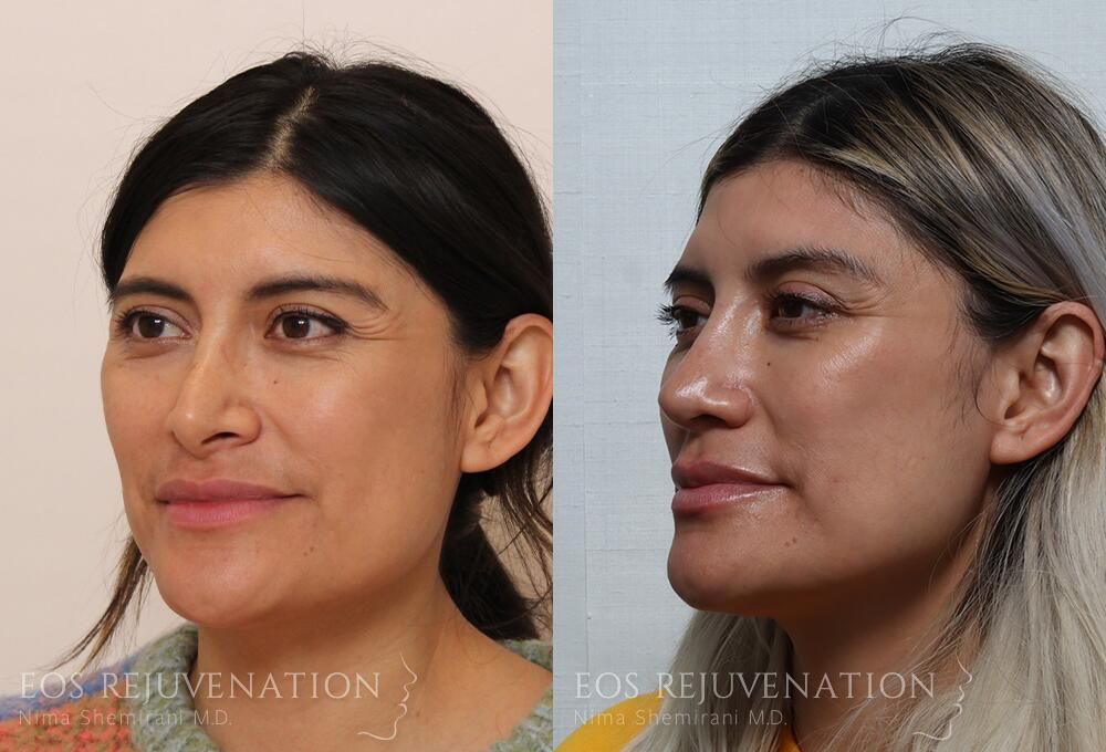 Revision Rhinoplasty Before & After