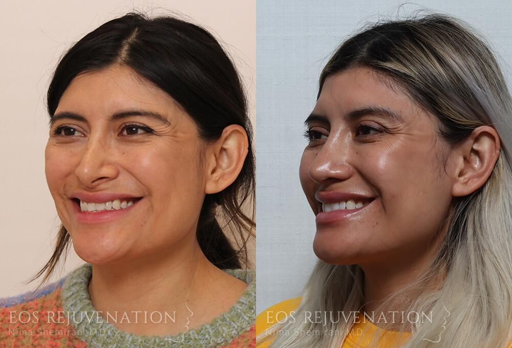 Revision Rhinoplasty Before & After